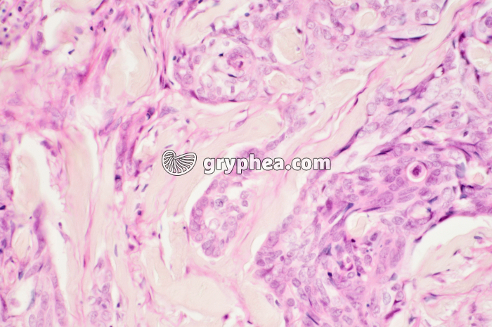 Cancer de la peau (détail) x100 - gryphea.org